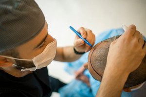 زراعة الشعر في ايران/افضل متخصص في زراعة الشعر